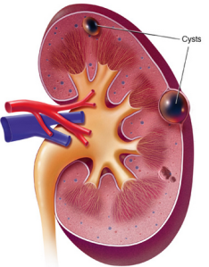 Micro Chinese Medicine For Kidney Cyst With Diabetes